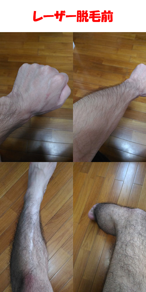 レーザー脱毛前