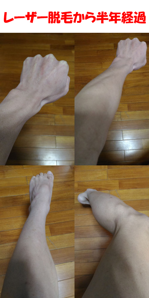 レーザー脱毛後