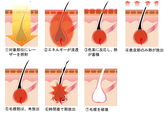 レーザー脱毛のしくみ